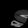 SPORK, NICO - 22.03.1976 - 02.08.2022 - CT obere Extremität - 17:51:17